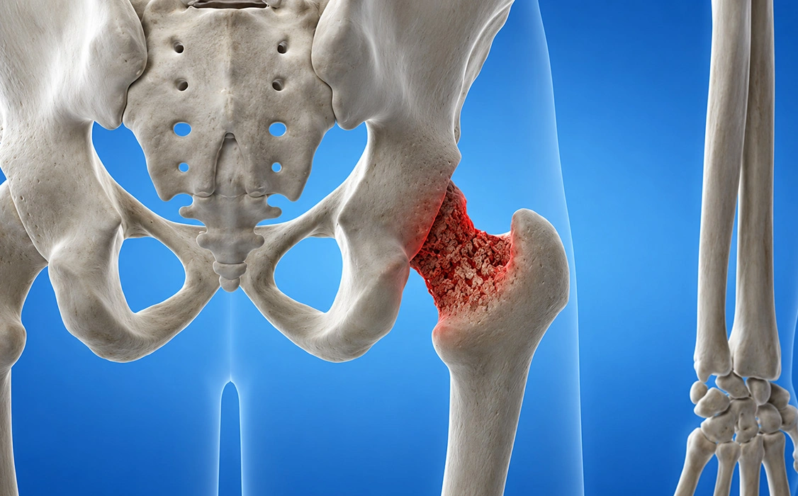 Diagnosis for Osteoporosis