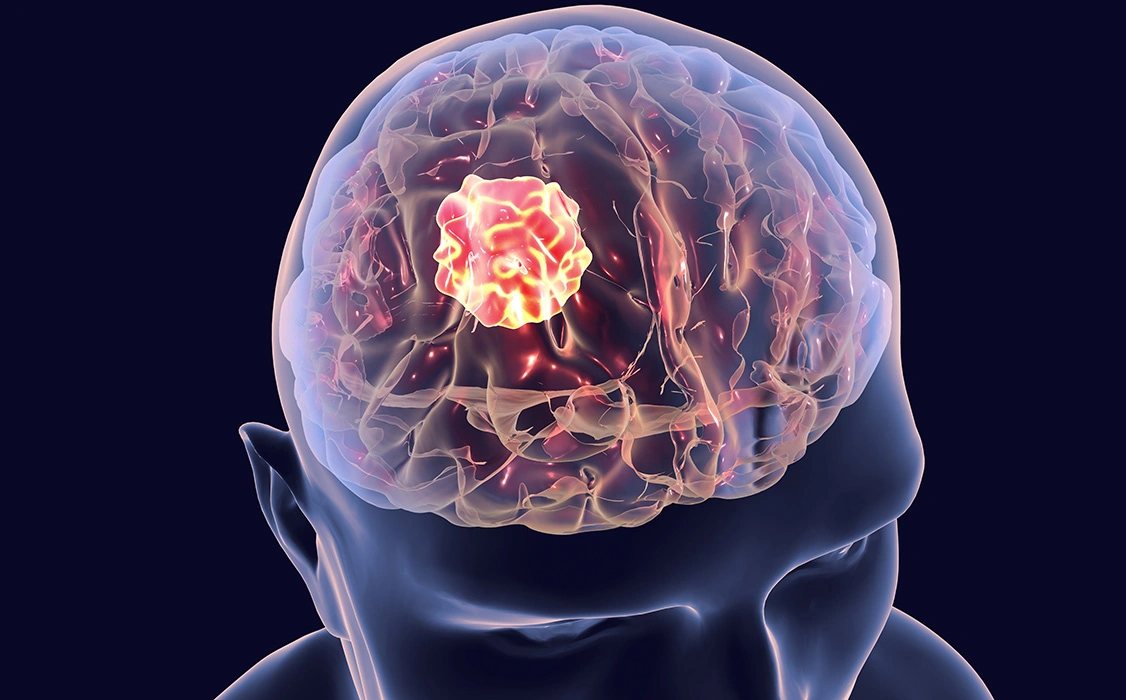 Diagnosis Before Brain Tumor Surgery