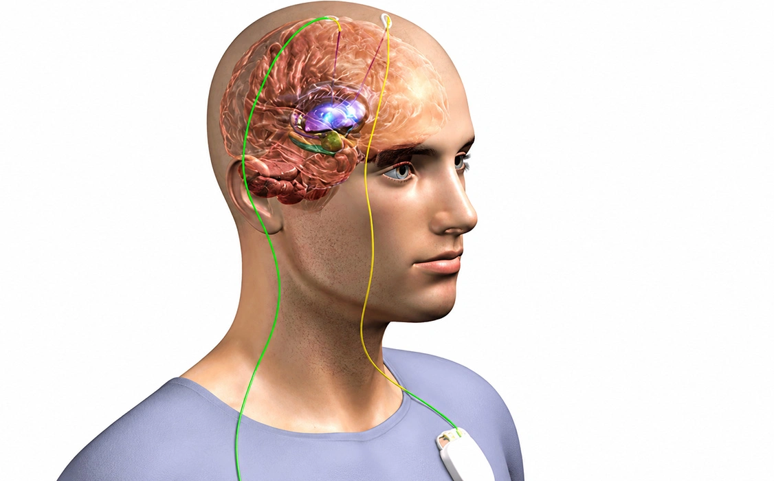 Recovery After DBS Treatment