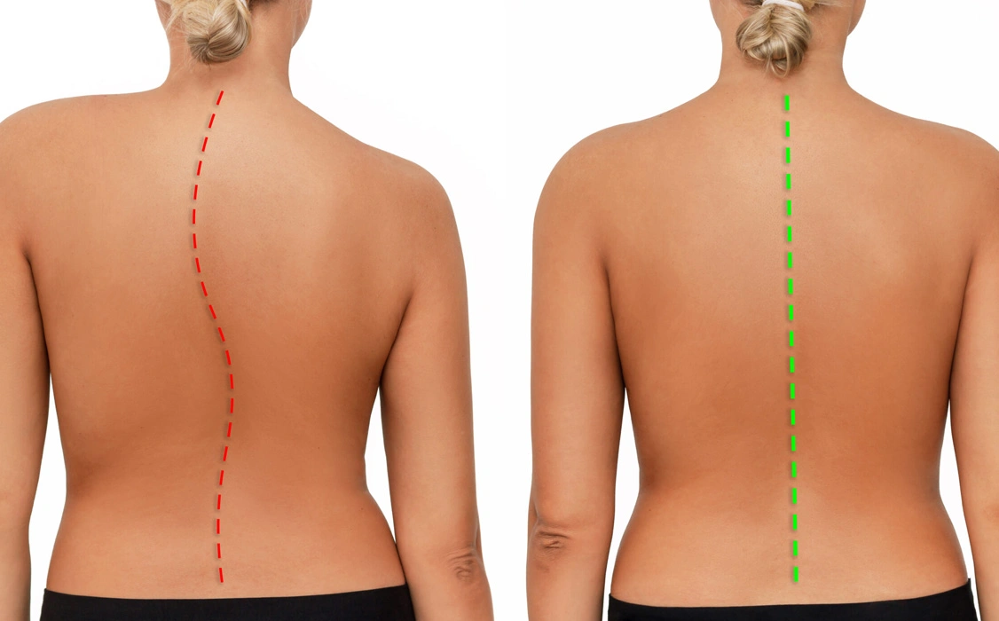 Diagnosis for Scoliosis