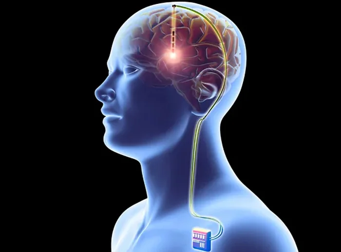 Evaluation Before Deep Brain Stimulation