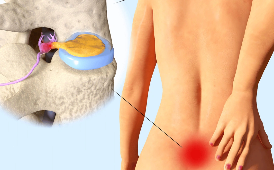 What is a Herniated Disc
